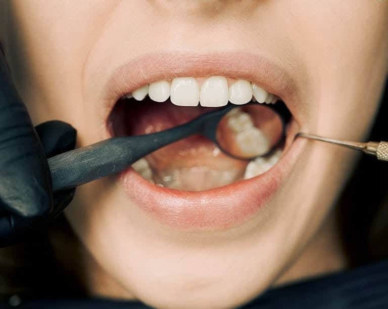 Smoking and Oral Health: 7 Alarming Changes Already Happening Inside Your Mouth 7 Close up of teeth and gums showing the damage caused by smoking and its alarming effects on oral health including gum disease and tooth loss