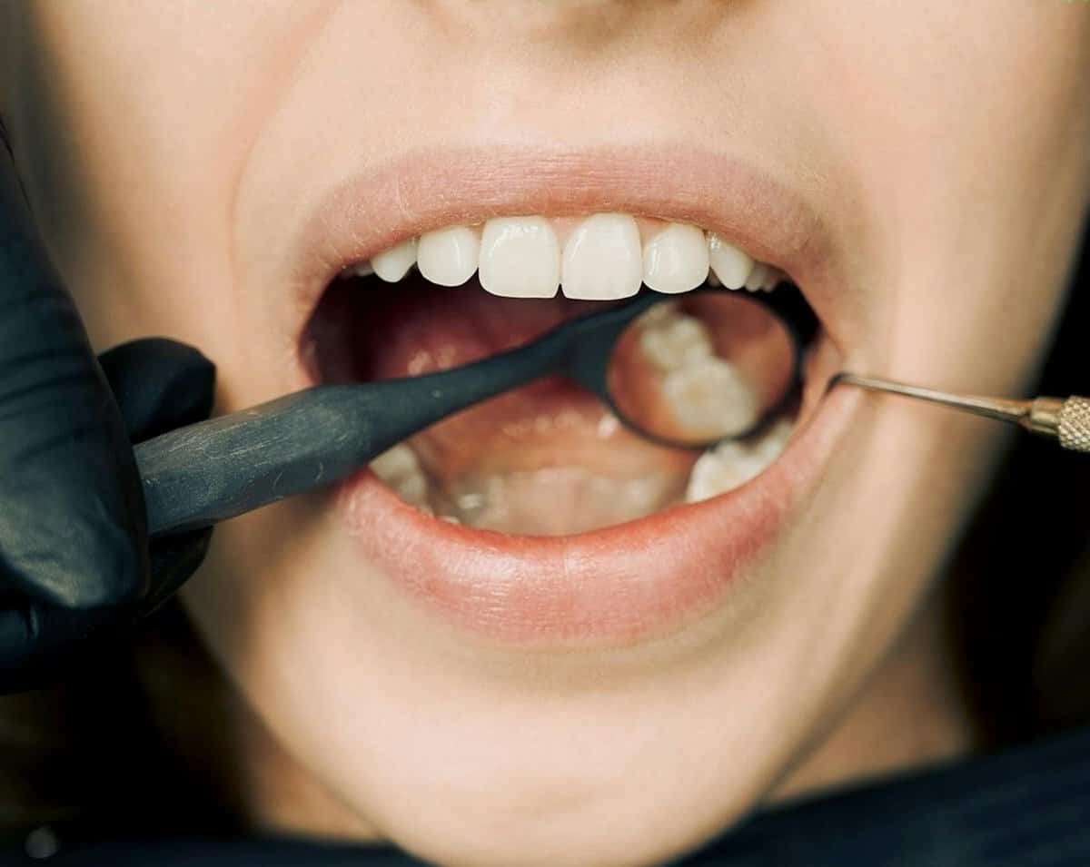 Smoking and Oral Health: 7 Alarming Changes Already Happening Inside Your Mouth 1 Close up of teeth and gums showing the damage caused by smoking and its alarming effects on oral health including gum disease and tooth loss